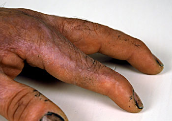 Finger med skada och &auml;rrbildning &copy; Eric Hammerin 